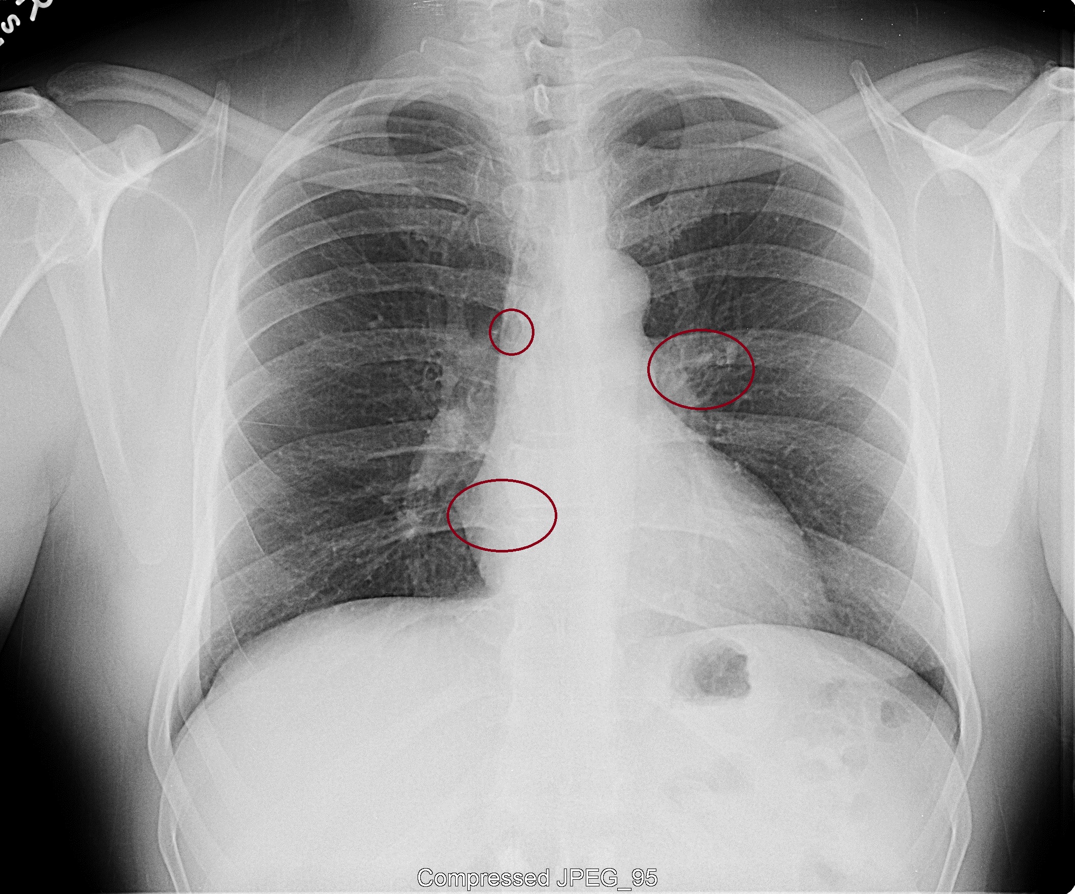 R. Cain Pueblo Radiology Chest Xray March 2, 2012