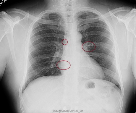R. Cain Pueblo Radiology Chest Xray March 2, 2012